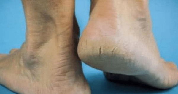 Lưu ý 3 vị trí đau cảnh báo bệnh thận - Hình 4 Luu y 3 vi tri dau canh bao benh than-Hinh-4