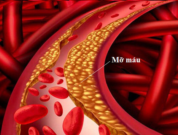 3 loại rau củ ăn nhiều tăng mỡ máu, hại sức khỏe - Hình 2 3 loai rau cu an nhieu tang mo mau, hai suc khoe-Hinh-2