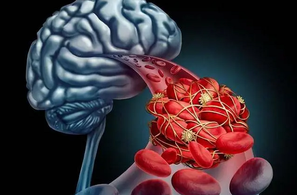 Những tín hiệu cảnh báo xuất huyết não không nên bỏ qua - Hình 13 Nhung tin hieu canh bao xuat huyet nao khong nen bo qua-Hinh-13