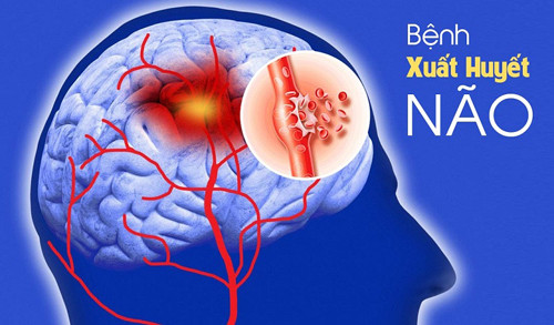 Những tín hiệu cảnh báo xuất huyết não không nên bỏ qua - Hình 3 Nhung tin hieu canh bao xuat huyet nao khong nen bo qua-Hinh-3