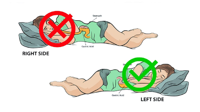 Bác sĩ khuyên 5 điều cực đơn giản giúp tránh xa bệnh trào ngược dạ dày - Hình 10 Bac si khuyen 5 dieu cuc don gian giup tranh xa benh trao nguoc da day-Hinh-10