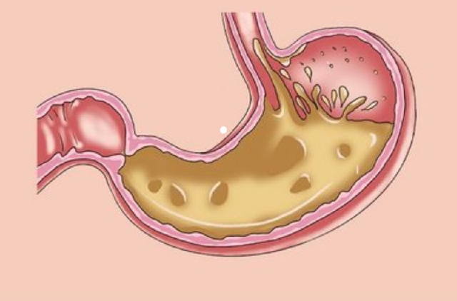 Những loại quả bổ dưỡng là “kẻ thù” của bệnh nhân dạ dày - Hình 2 Nhung loai qua bo duong la “ke thu” cua benh nhan da day-Hinh-2