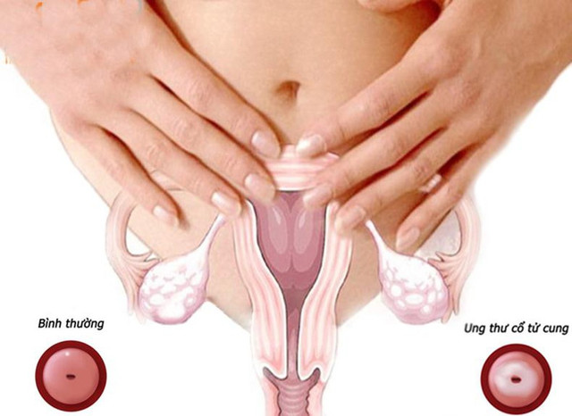 Cảnh báo những dấu hiệu của ung thư cổ tử cung - Hình 8 Canh bao nhung dau hieu cua ung thu co tu cung-Hinh-8