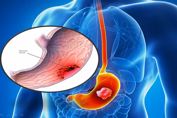 Mon an hang ngay khien cap vo chong cung mac K da day-Hinh-2