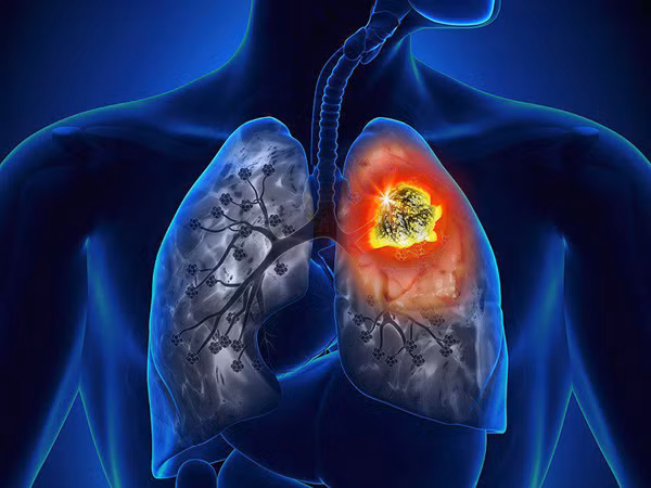 Chuyen gia chi cach phong ung thu phoi tu ca thuc tien-Hinh-11