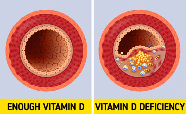 Canh bao lat dau hieu cho thay co the thieu vitamin D tram trong-Hinh-5