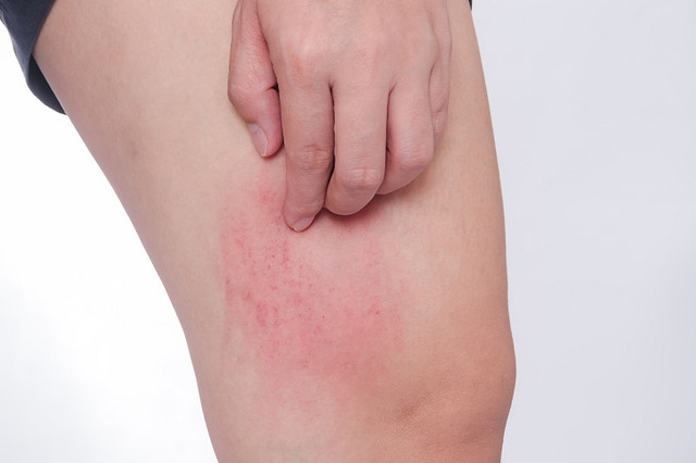 Loạt dấu hiệu bệnh tiểu đường cần chú ý - Hình 7 Loat dau hieu benh tieu duong can chu y-Hinh-7