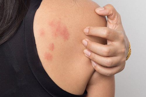 Loạt dấu hiệu bệnh tiểu đường cần chú ý - Hình 5 Loat dau hieu benh tieu duong can chu y-Hinh-5