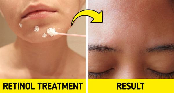 Cách trị mụn thịt tại nhà theo hướng dẫn của chuyên gia - Hình 10 Cach tri mun thit tai nha theo huong dan cua chuyen gia-Hinh-10