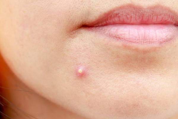 Cách trị mụn thịt tại nhà theo hướng dẫn của chuyên gia - Hình 3 Cach tri mun thit tai nha theo huong dan cua chuyen gia-Hinh-3