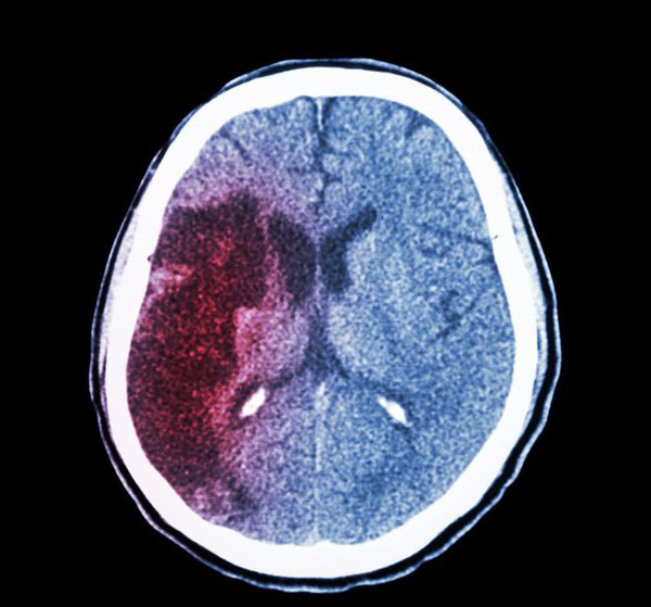 Dấu hiệu cảnh báo xuất huyết não cần hết sức cảnh giác Dau hieu canh bao xuat huyet nao can het suc canh giac