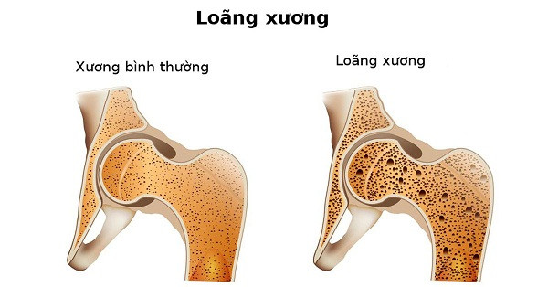 Mùa xuân là 'thời điểm vàng' bổ sung canxi - Hình 2 Mua xuan la 'thoi diem vang' bo sung canxi-Hinh-2