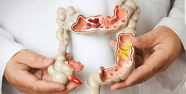 Tự phát hiện bệnh đường ruột nhờ dấu hiệu “1 đau, 1 đen, 3 mùi” - Hình 7 Tu phat hien benh duong ruot nho dau hieu “1 dau, 1 den, 3 mui”-Hinh-7