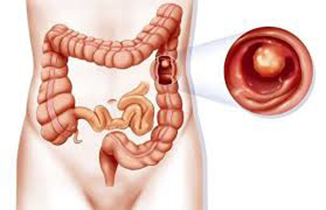 Lưu ý 4 bệnh vặt không chữa sớm dễ chuyển thành ung thư - Hình 2 Luu y 4 benh vat khong chua som de chuyen thanh ung thu-Hinh-2