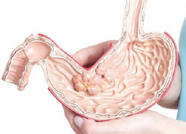 Lưu ý 4 bệnh vặt không chữa sớm dễ chuyển thành ung thư - Hình 10 Luu y 4 benh vat khong chua som de chuyen thanh ung thu-Hinh-10