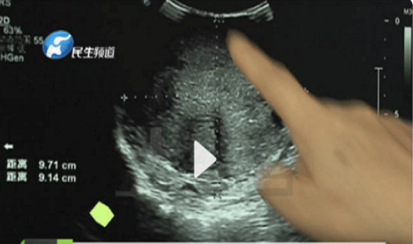 Bác sĩ khuyên gì từ vụ bé gái 15 tuổi mắc ung thư vú? Bac si khuyen gi tu vu be gai 15 tuoi mac ung thu vu?