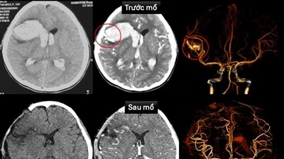 TP HCM: Cứu sống bệnh nhi bị dị dạng mạch máu não, bệnh tim hiếm gặp