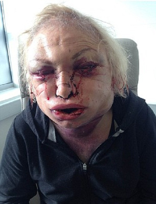 Kết quả là, giờ đây gương mặt bà bị sưng phù, biến dạng và bà cảm thấy thật đau đớn toàn bộ phần đầu của mình.