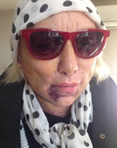 Kellie Maloney phải đeo kính và quấn khăn để che bớt những vết bầm tím trên khuôn mặt do dao kéo.