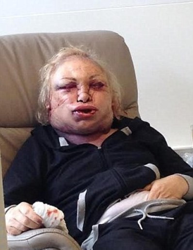 Sau 4 ngày tiến hành phẫu thuật, mặt bà này bị sưng vù, rớm màu và cần phải có thiết bị hỗ trợ chuyên dụng để thở.