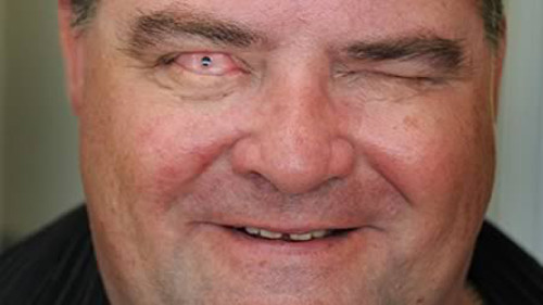 Cấy răng vào mắt. Người đàn ông ở Anh này từng bị mù, nhưng sau khi lấy răng nanh của mình ra cấy vào mắt thì ông lại có thể nhìn được