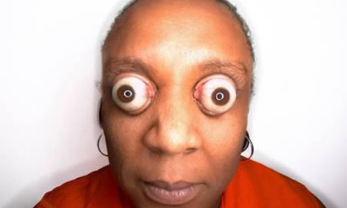 Nhãn cầu lồi xa nhất. Một người phụ nữ tại Chicago có đôi nhãn cầu lồi xa khỏi hốc mắt khoảng 12mm. Cô cảm thấy dường như mỗi ngày nó càng lồi xa hơn.