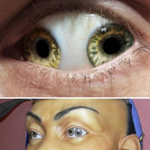 Mắt có 2 con ngươi. Hiện tượng kỳ lạ này đã khiến cả thế giới choáng váng. Bởi trong y học, việc xuất hiện 2 con ngươi trong một mắt là điều chưa từng có.