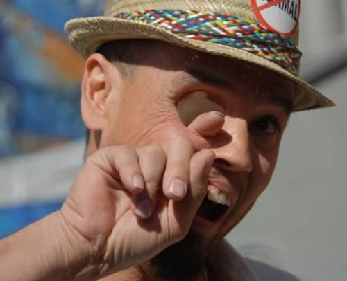 Không có mắt phải. Một người đàn ông Mỹ đã phải gỡ bỏ nửa khuôn mặt, trong đó có cả mắt bên phải vì một dạng ung thư hiếm gặp.