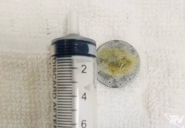 Viên pin điện tử dạng cúc áo có đường kính khoảng 3cm vừa được các bác sĩ Bệnh viện Đa khoa Bắc Kạn gắp thành công ra khỏi cơ thể trẻ. Ảnh Bệnh viện