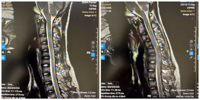 MRI tư thế trung gian và MRI tư thế gập cổ