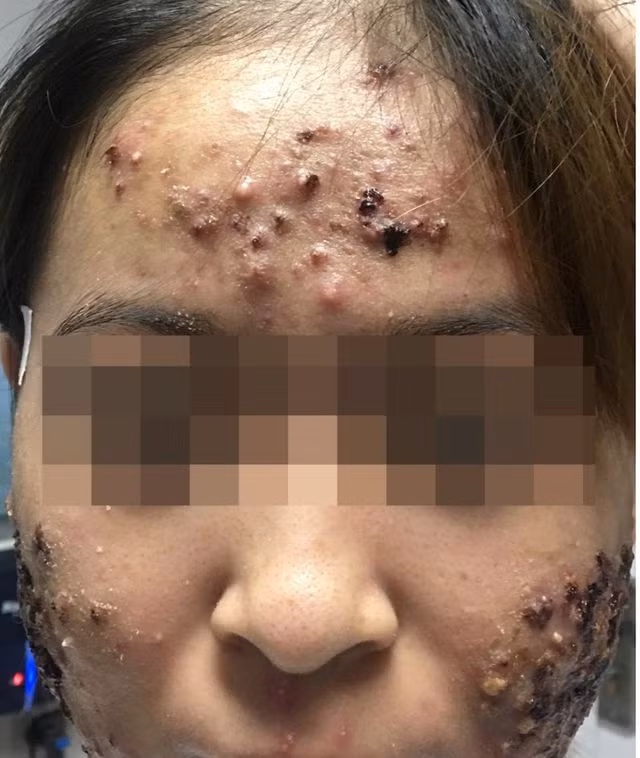 Phát hoảng những khuôn mặt biến dạng vì thuốc trị mụn mua trên mạng - Hình 3 Phat hoang nhung khuon mat bien dang vi thuoc tri mun mua tren mang-Hinh-3