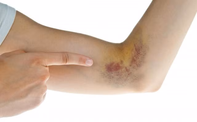 Vết bầm quanh rốn cảnh báo ung thư gan giai đoạn cuối - Hình 5 Vet bam quanh ron canh bao ung thu gan giai doan cuoi-Hinh-5