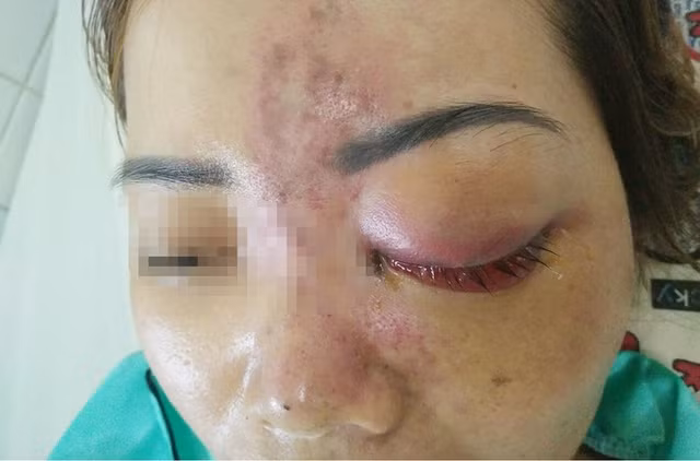 Chị em cẩn trọng với loạt trường hợp mù mắt vì tiêm filler nâng mũi - Hình 3 Chi em can trong voi loat truong hop mu mat vi tiem filler nang mui-Hinh-3