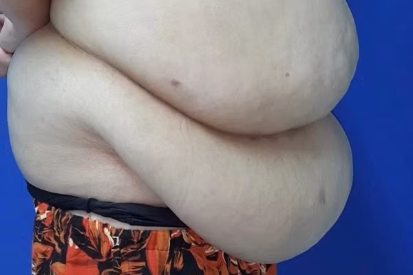 Bà mẹ béo phì được phẫu thuật cắt 7kg da, mỡ thừa Ba me beo phi duoc phau thuat cat 7kg da, mo thua