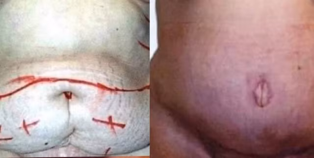 Bà mẹ béo phì được phẫu thuật cắt 7kg da, mỡ thừa - Hình 4 Ba me beo phi duoc phau thuat cat 7kg da, mo thua-Hinh-4