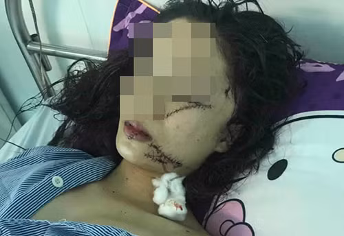 Nguyên nhân 2 thiếu nữ rạch mặt nhau kinh hoàng ở Bắc Ninh Nguyen nhan 2 thieu nu rach mat nhau kinh hoang o Bac Ninh