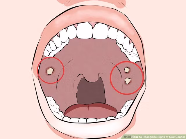 Dấu hiệu ung thư miệng cần cảnh giác - Hình 5 Dau hieu ung thu mieng can canh giac-Hinh-5