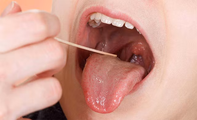 Dấu hiệu ung thư miệng cần cảnh giác - Hình 2 Dau hieu ung thu mieng can canh giac-Hinh-2