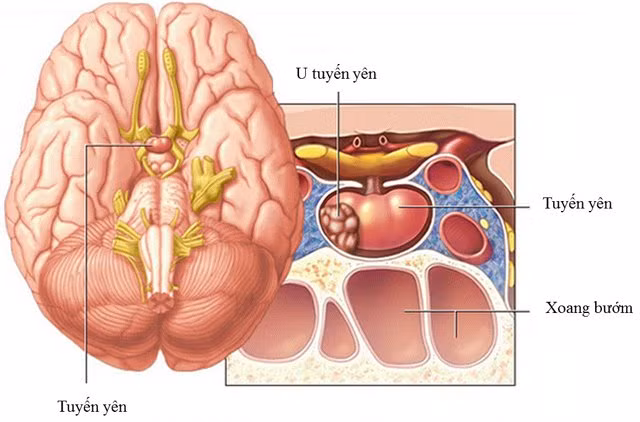 Ca sĩ Ánh Tuyết bị u tuyến yên: Cách phòng ngừa như nào? - Hình 2 Ca si Anh Tuyet bi u tuyen yen: Cach phong ngua nhu nao?-Hinh-2