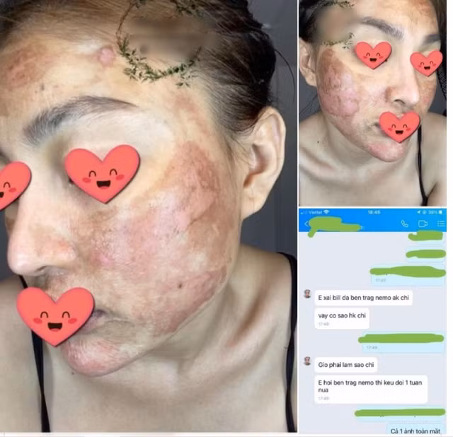 Chuyên gia Facebook, Tiktok dạy làm đẹp: Mạng ảo nhưng biến chứng là thật Chuyen gia Facebook, Tiktok day lam dep: Mang ao nhung bien chung la that