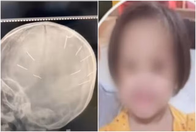 Lời kể của gã cha dượng đóng đinh vào đầu bé 3 tuổi - Hình 11 Loi ke cua ga cha duong dong dinh vao dau be 3 tuoi-Hinh-11
